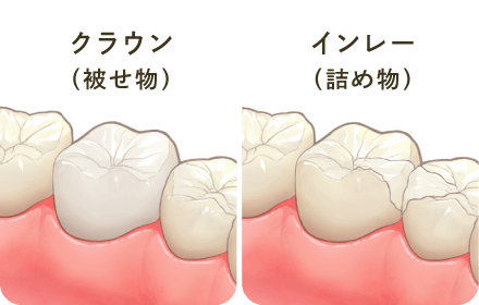 クラウン（被せ物）/インレー（詰め物）