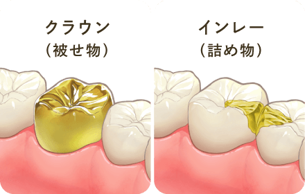 クラウン（被せ物）/インレー（詰め物）