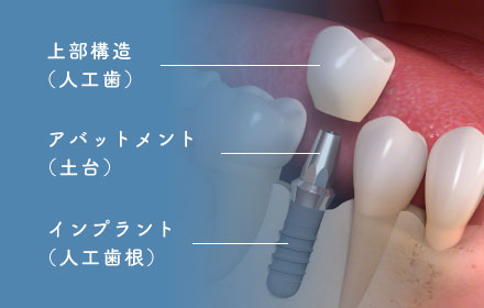 上部構造（人工歯）/アパットメント（土台）/インプラント（人工歯根）