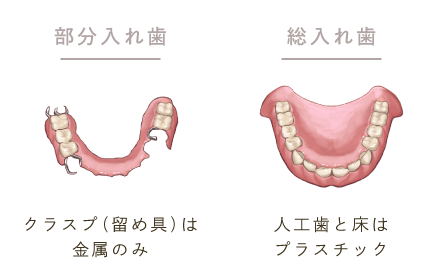 部分入れ歯：クラスプ（留め具）は金属のみ/総入れ歯：人工歯と床はプラスチック
